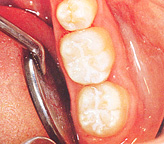 シーラント・虫歯予防